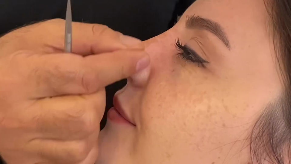 Met Clinics Dr. Mithat Topal Rhinoplasty Nose Job Patient Result